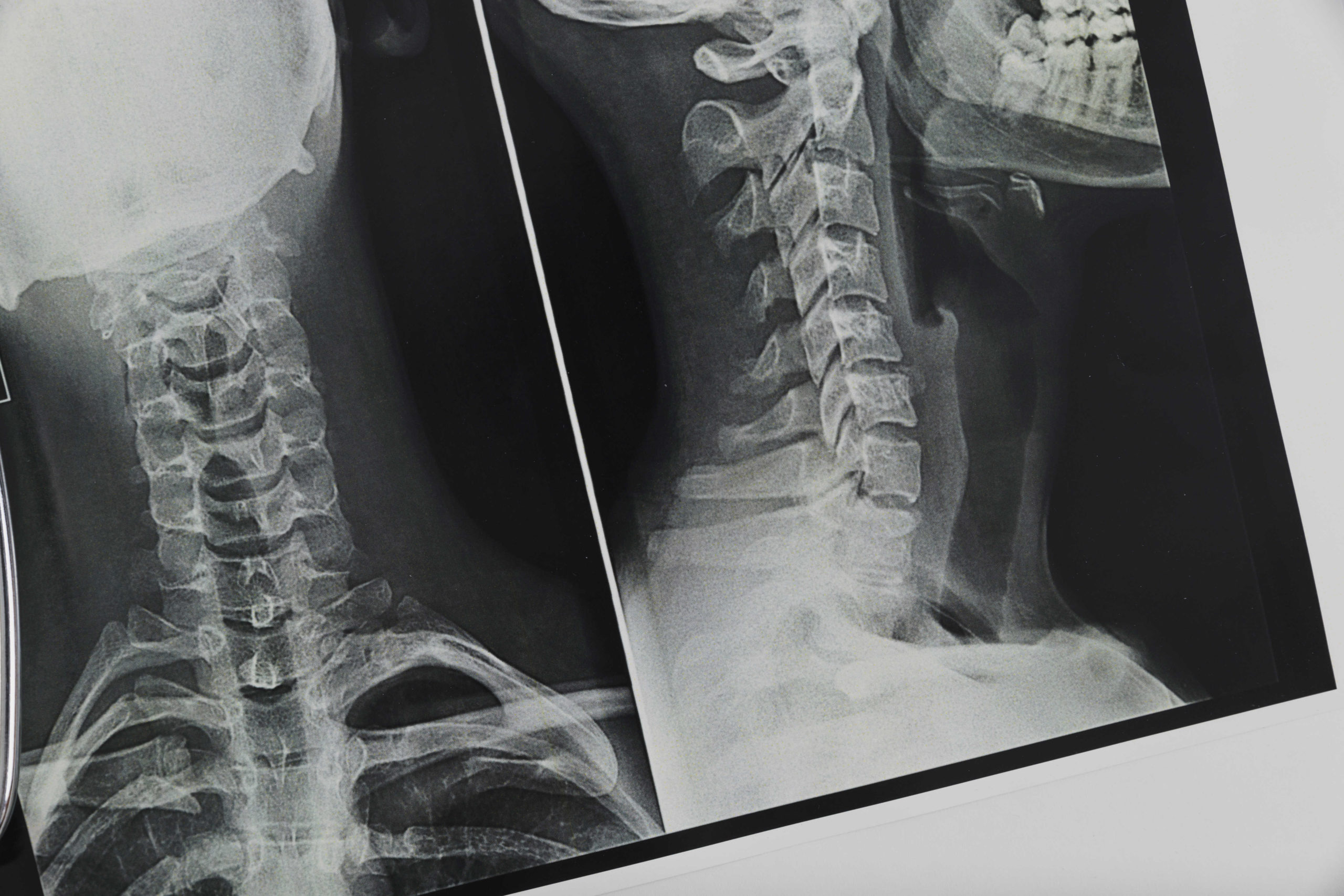 x ray